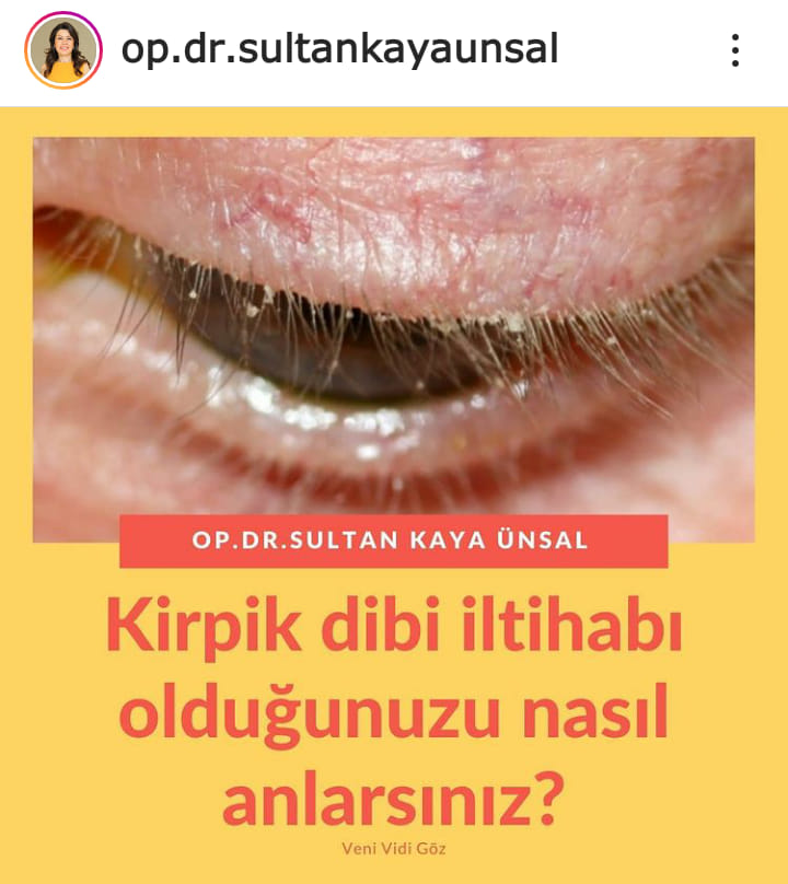  - rosacea ilişkisi 