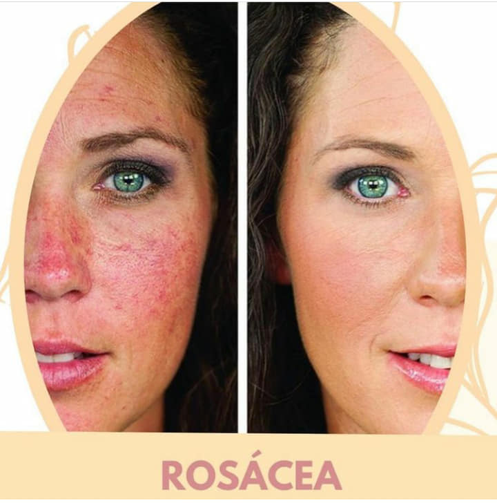rosa ( gül ) hastalığı tedavisi hakkında…