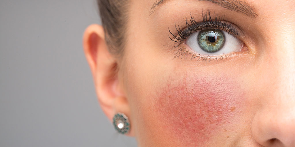 rosacea olsam uzun demez okurdum