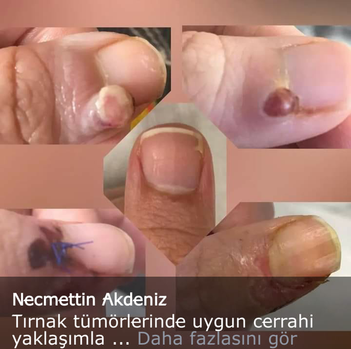 tırnak tümörlerinde cerrahi yaklaşım