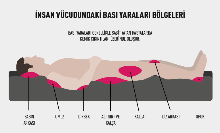 yatak yaraları